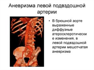 Аневризма в подвздошной области инвалидность