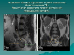 Аневризма в подвздошной области инвалидность
