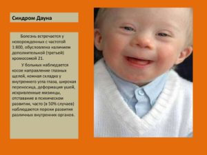 Синдром дауна передается по наследству или нет